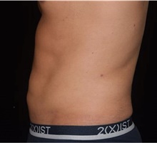 Liposuction After Photo by David Rapaport, MD; New York, NY - Case 46563