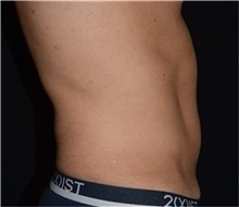 Liposuction Before Photo by David Rapaport, MD; New York, NY - Case 46563