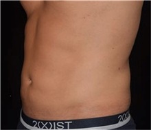 Liposuction After Photo by David Rapaport, MD; New York, NY - Case 46563