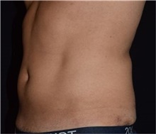Liposuction Before Photo by David Rapaport, MD; New York, NY - Case 46563
