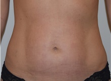 Liposuction After Photo by David Rapaport, MD; New York, NY - Case 46564