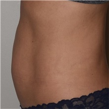 Liposuction After Photo by David Rapaport, MD; New York, NY - Case 46564