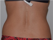 Liposuction Before Photo by David Rapaport, MD; New York, NY - Case 46564