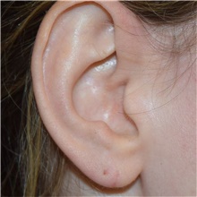 Ear Reconstruction Surgery After Photo by David Rapaport, MD; New York, NY - Case 46565