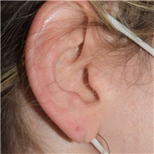 Ear Reconstruction Surgery Before Photo by David Rapaport, MD; New York, NY - Case 46565