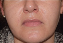 Skin rejuvenation and resurfacing After Photo by David Rapaport, MD; New York, NY - Case 46590