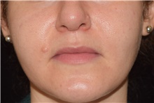 Skin rejuvenation and resurfacing Before Photo by David Rapaport, MD; New York, NY - Case 46590