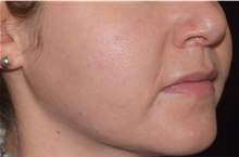 Skin rejuvenation and resurfacing After Photo by David Rapaport, MD; New York, NY - Case 46590
