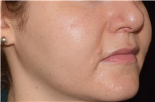 Skin rejuvenation and resurfacing Before Photo by David Rapaport, MD; New York, NY - Case 46590