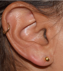 Ear Surgery After Photo by David Rapaport, MD; New York, NY - Case 46834