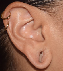 Ear Surgery Before Photo by David Rapaport, MD; New York, NY - Case 46834