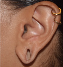 Ear Surgery Before Photo by David Rapaport, MD; New York, NY - Case 46834