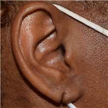 Ear Surgery Before Photo by David Rapaport, MD; New York, NY - Case 47092