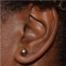 Ear Surgery After Photo by David Rapaport, MD; New York, NY - Case 47092