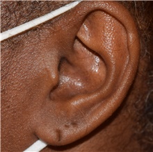 Ear Surgery Before Photo by David Rapaport, MD; New York, NY - Case 47092