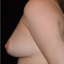 Breast Lift After Photo by David Rapaport, MD; New York, NY - Case 47096