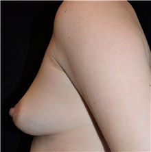 Breast Lift Before Photo by David Rapaport, MD; New York, NY - Case 47096