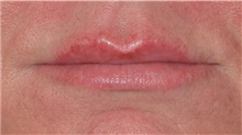 Injectable Fillers After Photo by David Rapaport, MD; New York, NY - Case 47097