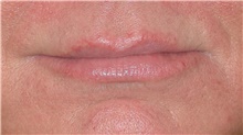 Injectable Fillers Before Photo by David Rapaport, MD; New York, NY - Case 47097