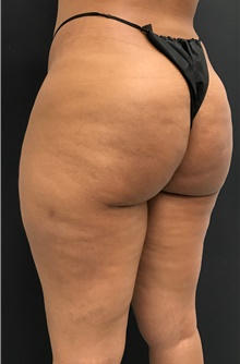 Body Contouring After Photo by David Rapaport, MD; New York, NY - Case 47099