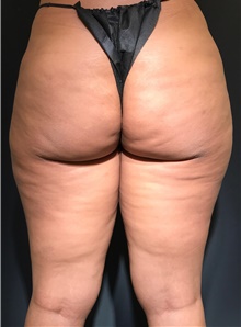 Body Contouring After Photo by David Rapaport, MD; New York, NY - Case 47099