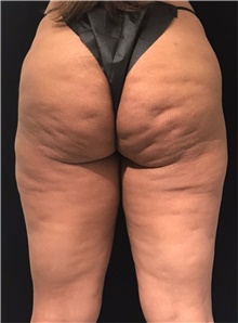 Body Contouring Before Photo by David Rapaport, MD; New York, NY - Case 47099