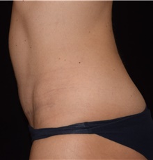 Tummy Tuck After Photo by David Rapaport, MD; New York, NY - Case 47100