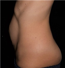 Tummy Tuck Before Photo by David Rapaport, MD; New York, NY - Case 47100