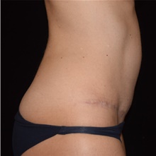 Tummy Tuck After Photo by David Rapaport, MD; New York, NY - Case 47100