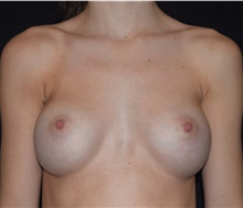 Breast Augmentation After Photo by David Rapaport, MD; New York, NY - Case 47102