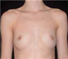 Breast Augmentation Before Photo by David Rapaport, MD; New York, NY - Case 47102
