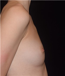 Breast Augmentation Before Photo by David Rapaport, MD; New York, NY - Case 47102