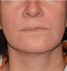 Injectable Fillers After Photo by David Rapaport, MD; New York, NY - Case 47103