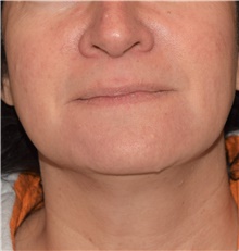 Injectable Fillers Before Photo by David Rapaport, MD; New York, NY - Case 47103