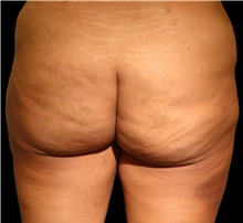 Body Contouring After Photo by David Rapaport, MD; New York, NY - Case 47104