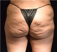 Body Contouring Before Photo by David Rapaport, MD; New York, NY - Case 47104