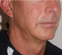 Laser Skin Resurfacing After Photo by David Rapaport, MD; New York, NY - Case 47158