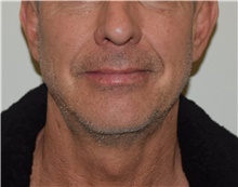 Laser Skin Resurfacing Before Photo by David Rapaport, MD; New York, NY - Case 47158