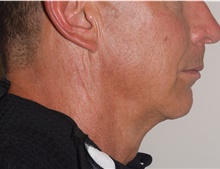 Laser Skin Resurfacing After Photo by David Rapaport, MD; New York, NY - Case 47158