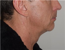 Laser Skin Resurfacing Before Photo by David Rapaport, MD; New York, NY - Case 47158
