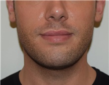 Laser Skin Resurfacing After Photo by David Rapaport, MD; New York, NY - Case 47159