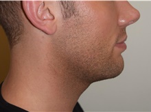 Laser Skin Resurfacing After Photo by David Rapaport, MD; New York, NY - Case 47159