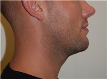 Laser Skin Resurfacing Before Photo by David Rapaport, MD; New York, NY - Case 47159