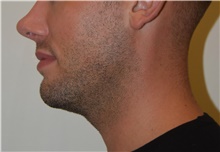 Laser Skin Resurfacing Before Photo by David Rapaport, MD; New York, NY - Case 47159