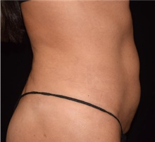 Liposuction After Photo by David Rapaport, MD; New York, NY - Case 47160