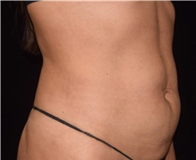 Liposuction After Photo by David Rapaport, MD; New York, NY - Case 47160