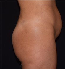 Liposuction Before Photo by David Rapaport, MD; New York, NY - Case 47160