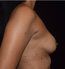 Breast Implant Revision After Photo by David Rapaport, MD; New York, NY - Case 47161