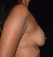 Breast Implant Revision Before Photo by David Rapaport, MD; New York, NY - Case 47161