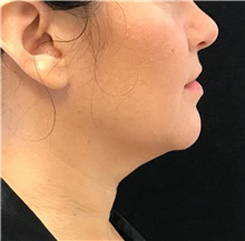 Nonsurgical Fat Reduction Before Photo by David Rapaport, MD; New York, NY - Case 47165